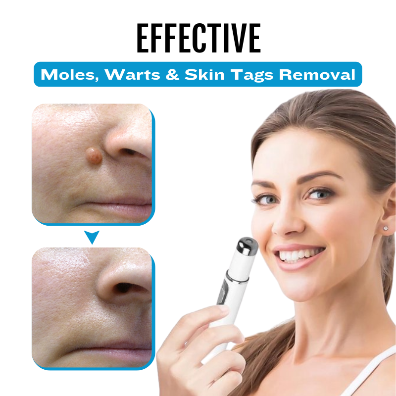 Bikenda® SpotlessDerm Mole and Wart Laser Pen-A