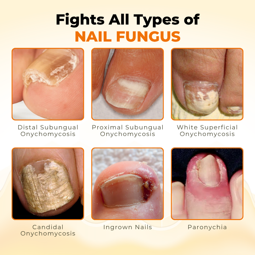 Timilk® NailRevive Bee Venom Anti-fungi Solution