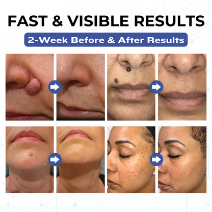 Timilk® VanishPro Skin Spot Removal Cream